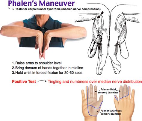 median nerve compression test carpal tunnel|reverse phalen's test positive.